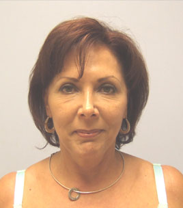 Facelift Before & After Image