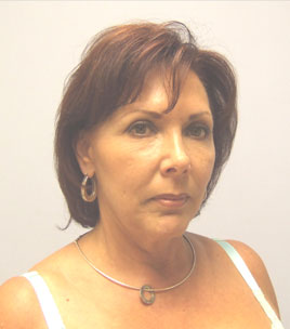 Facelift Before & After Image