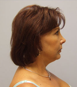 Facelift Before & After Image