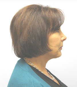 Facelift Before & After Image