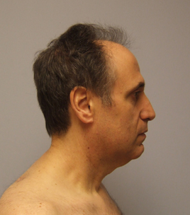 Facelift Before & After Image