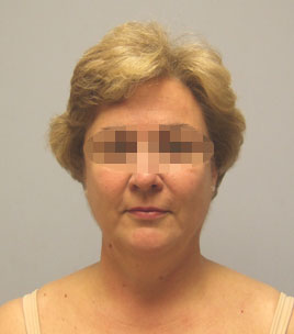 Facelift Before & After Image