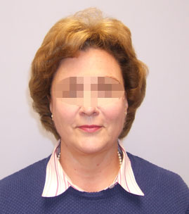 Facelift Before & After Image