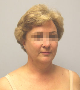 Facelift Before & After Image