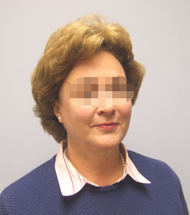 Facelift Before & After Image