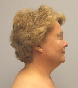 Facelift Before & After Image