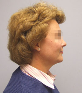 Facelift Before & After Image