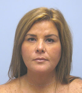 Facelift Before & After Image