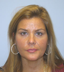 Facelift Before & After Image