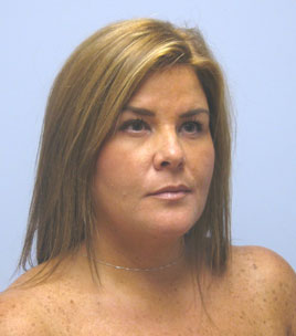 Facelift Before & After Image