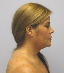 Facelift Before & After Image