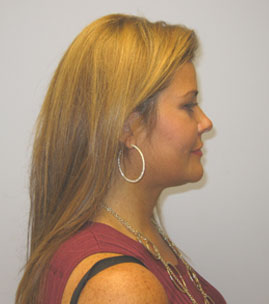 Facelift Before & After Image