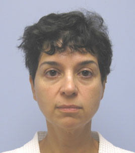 Facelift Before & After Image