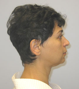 Facelift Before & After Image