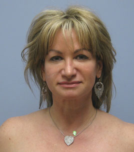 Facelift Before & After Image