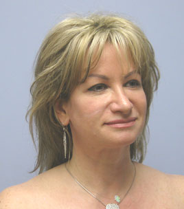 Facelift Before & After Image