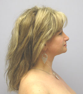 Facelift Before & After Image