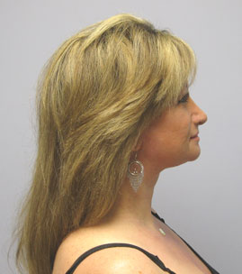 Facelift Before & After Image