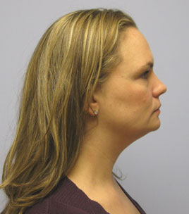 Facelift Before & After Image