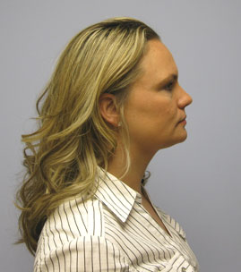 Facelift Before & After Image