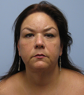 Facelift Before & After Image