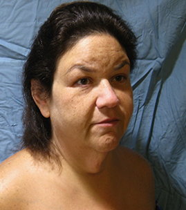 Facelift Before & After Image