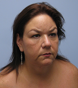 Facelift Before & After Image