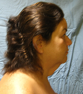 Facelift Before & After Image