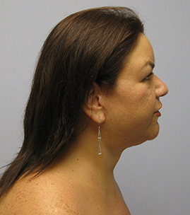 Facelift Before & After Image