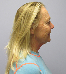 Facelift Before & After Image