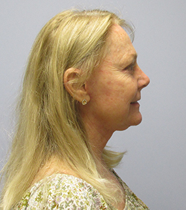 Facelift Before & After Image